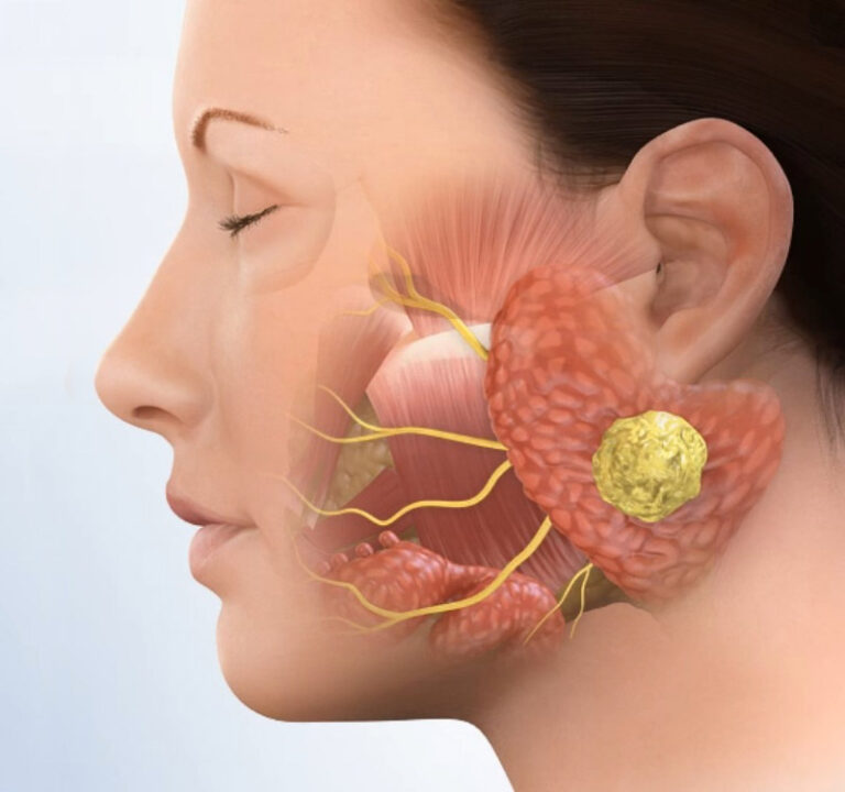 after-parotid-gland-surgery-1