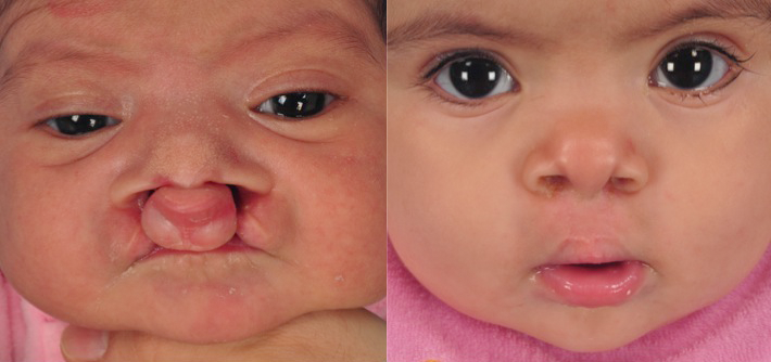 bilateral+cleft+lip